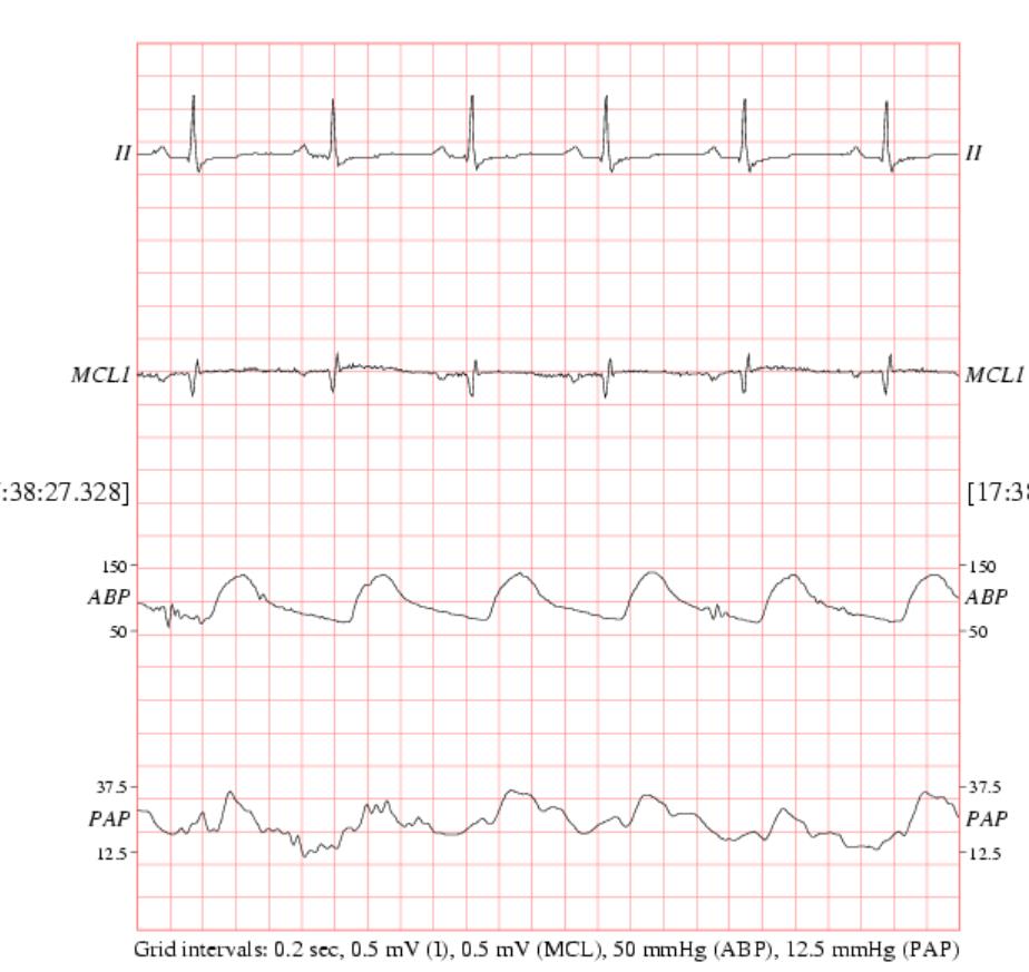 MIMIC-Waveform 生理信号数据